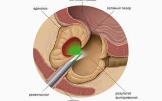 Лазерная вапоризация аденомы предстательной железы