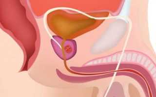 Симптомы и лечение абсцесса простаты у мужчин