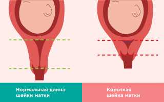 Короткая шейка матки при беременности