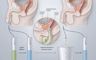 Норма макрофагов, эпителиев и эритроцитов в соке простаты