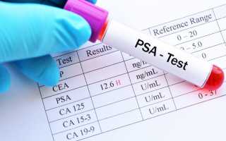 Нормальный уровень ПСА при раке простаты и после операции по ее удалению