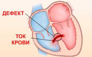 Врожденные пороки сердца