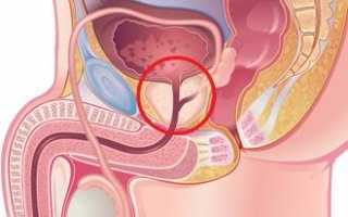 Истории о простатите