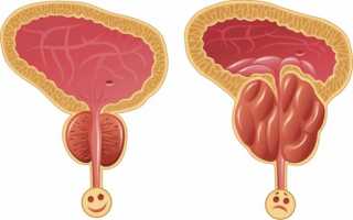 Что такое простатовезикулит, как определить и лечить болезнь