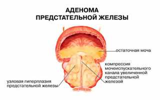 Лапароскопия для удаление аденомы простаты