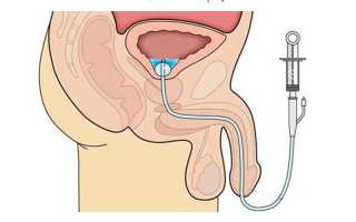 Электростимуляция предстательной железы прибором (видеоурок с отзывами)