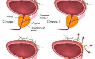 Как определить стадию рака простаты: характерные признаки