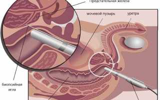Как проводят биопсию простаты при аденоме: типы, показатели