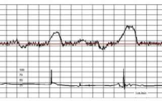 КТГ при беременности