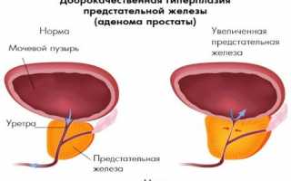 Обзор лекарственных препаратов для лечения аденомы простаты у мужчин