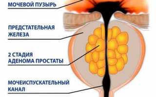 Что нужно знать о первых признаках аденомы предстательной железы и ее лечении