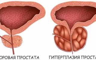 Детально о причинах, симптомах и лечении гиперплазии простаты