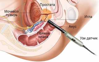Трансректальное УЗИ простаты у мужчин