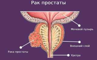 Рак предстательной железы 2 стадии