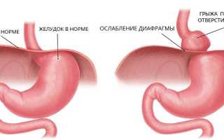 Диафрагмальная грыжа