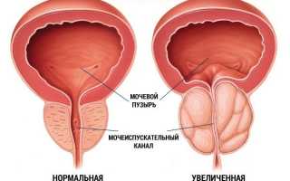 История Стюарта о жизни с хроническим простатитом