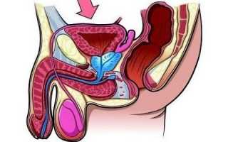 Вирусный простатит у мужчин