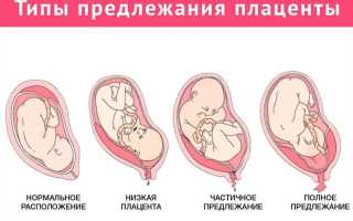 Предлежание плаценты