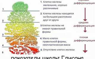 Классификация по Глисону онкологии простаты