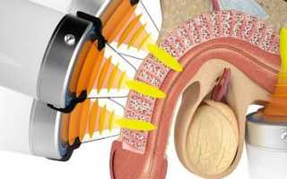 Лечение простатита и аденомы простаты ударно-волновой терапией