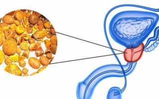 Что такое калькулезный простатит (калькулез предстательной железы)