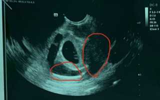 Гематома при беременности в матке