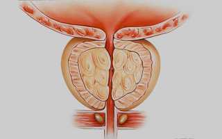 Что такое конгестия простаты (хронический конгестивный простатит)