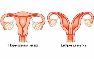 Двурогая матка и беременность