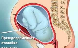 Преждевременная отслойка нормально расположенной плаценты