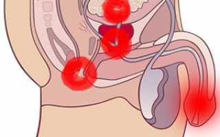 Локализация болей при простатите у мужчин, характер и способы их снятия