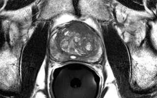 Подготовка к МРТ предстательной железы — эффективность процедуры и ее стоимость