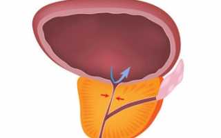 Причины, признаки и терапия доброкачественных новообразований простаты