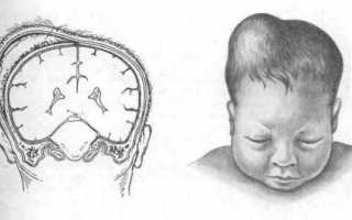 Кефалогематома у новорожденного