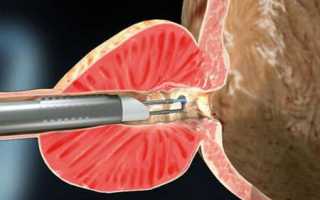 Что такое энуклеация простаты: техника выполнения и осложнения