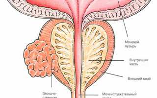 Рак простаты первой стадии