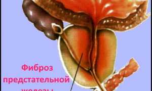 Что такое фиброз предстательной железы (фиброзный простатит)