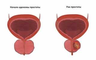 Последствия и осложнения простатита