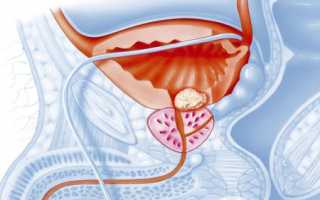 Описание симптомов и лечения хронического абактериального простатита