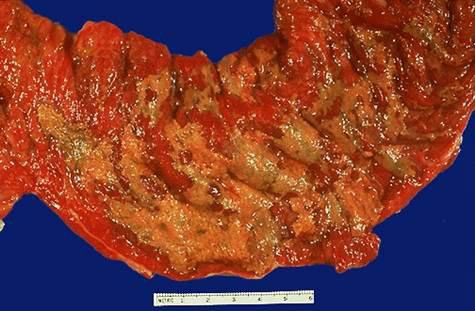 кишечник при псевдомембранозном колите