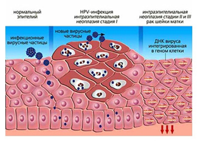 развитие вирус ВПЧ -инфекции